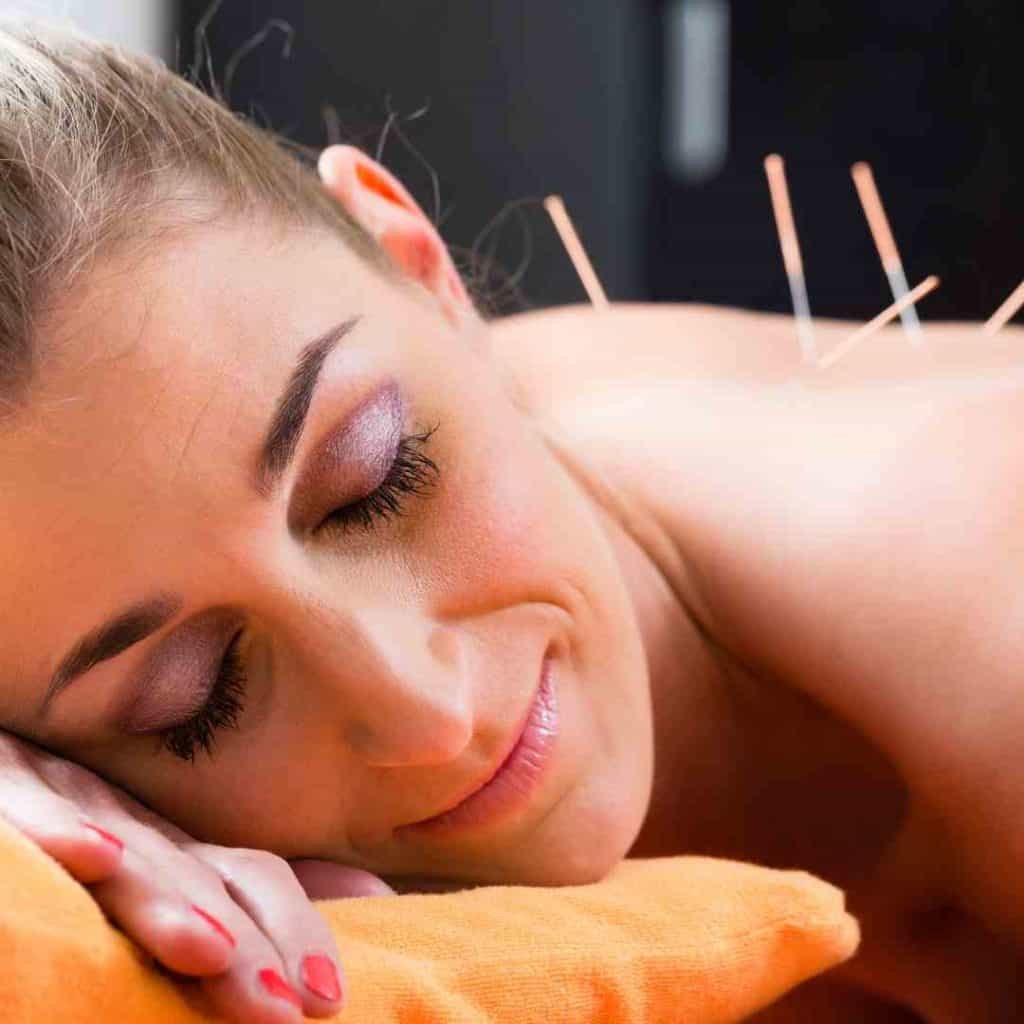 acupuncture